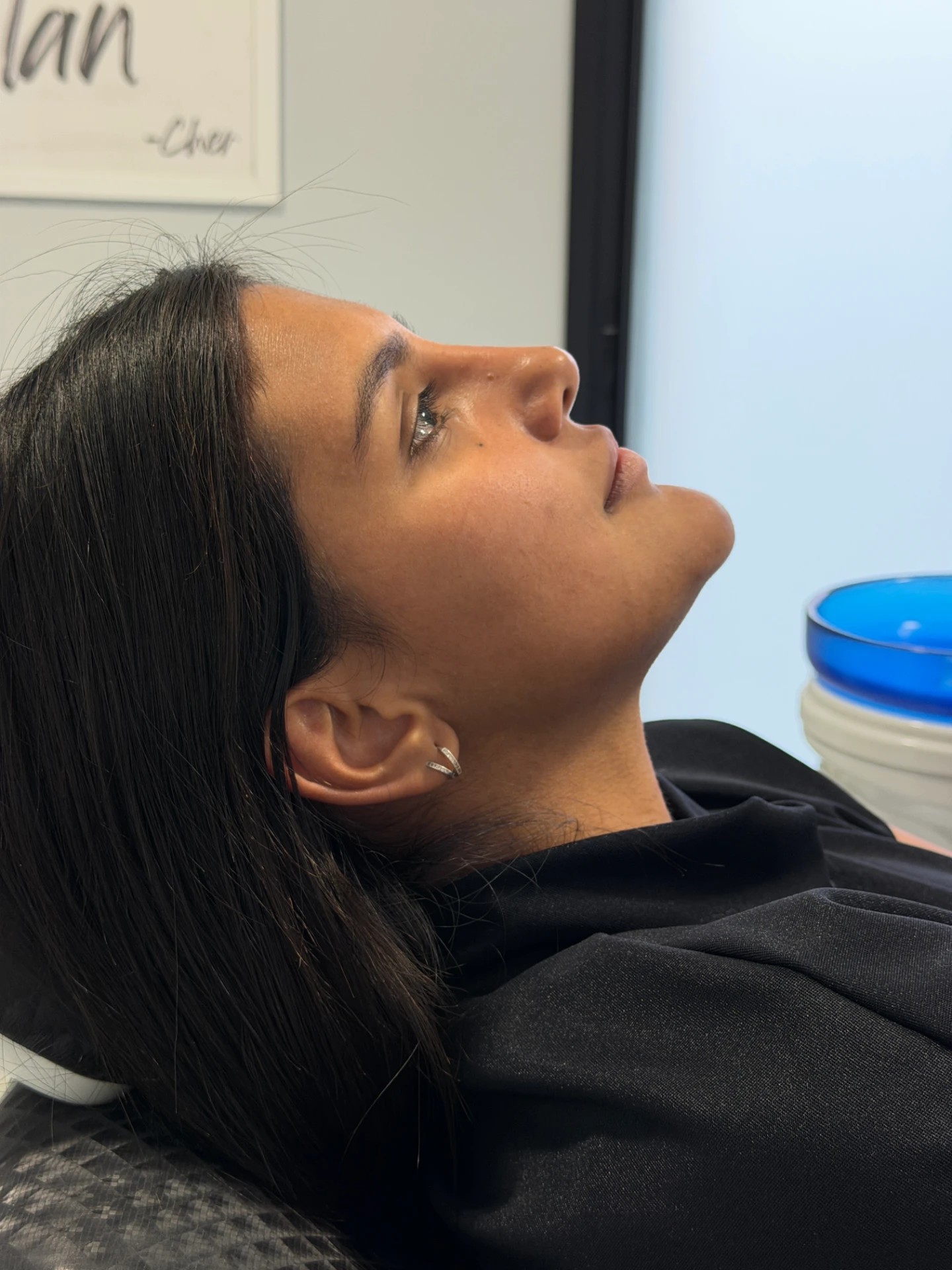 Harmonização facial — proporção e realce dos traços naturais — antes do tratamento