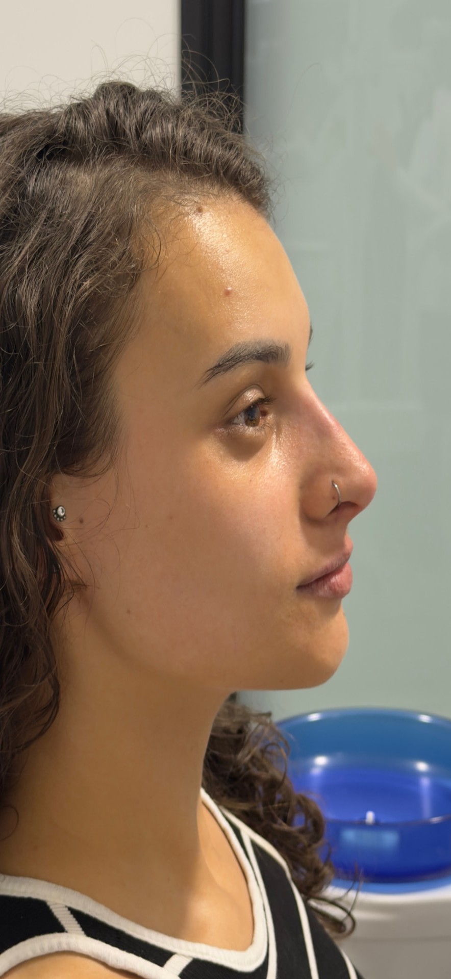 Harmonização facial — equilíbrio de perfil e contorno labial — depois do tratamento