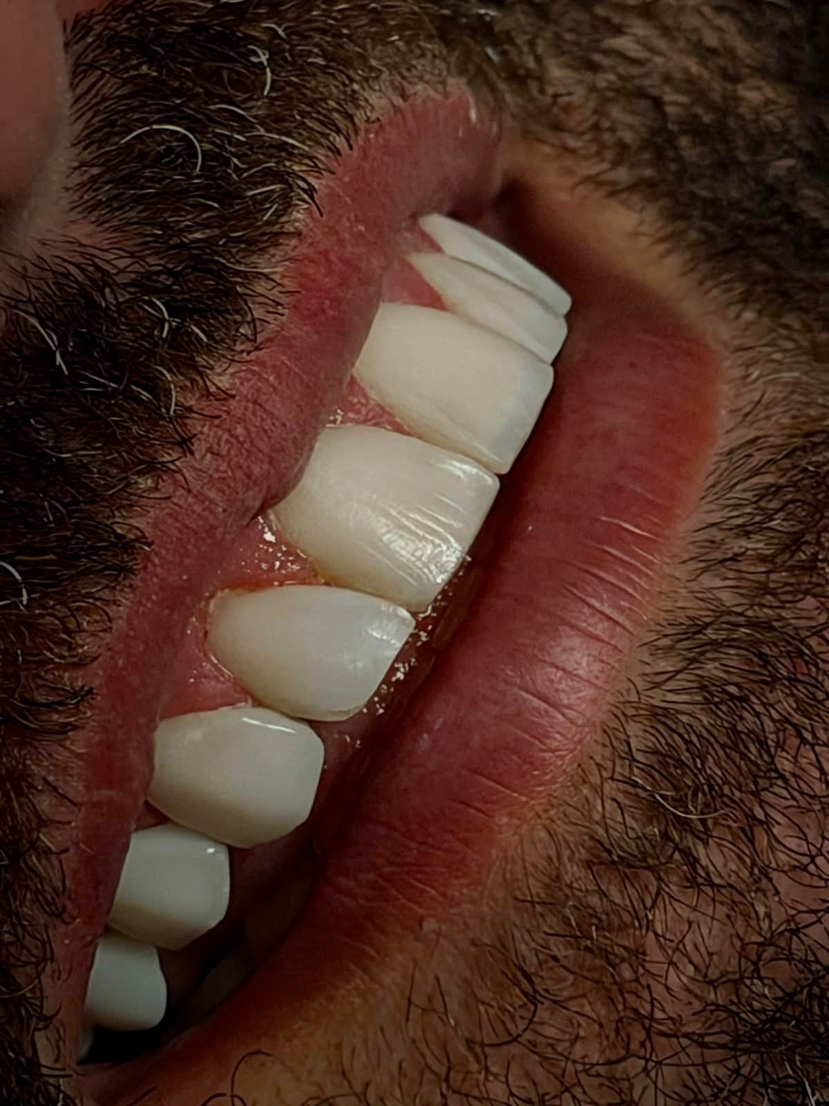 Detalhe de facetas em resina com aspecto natural e translucidez