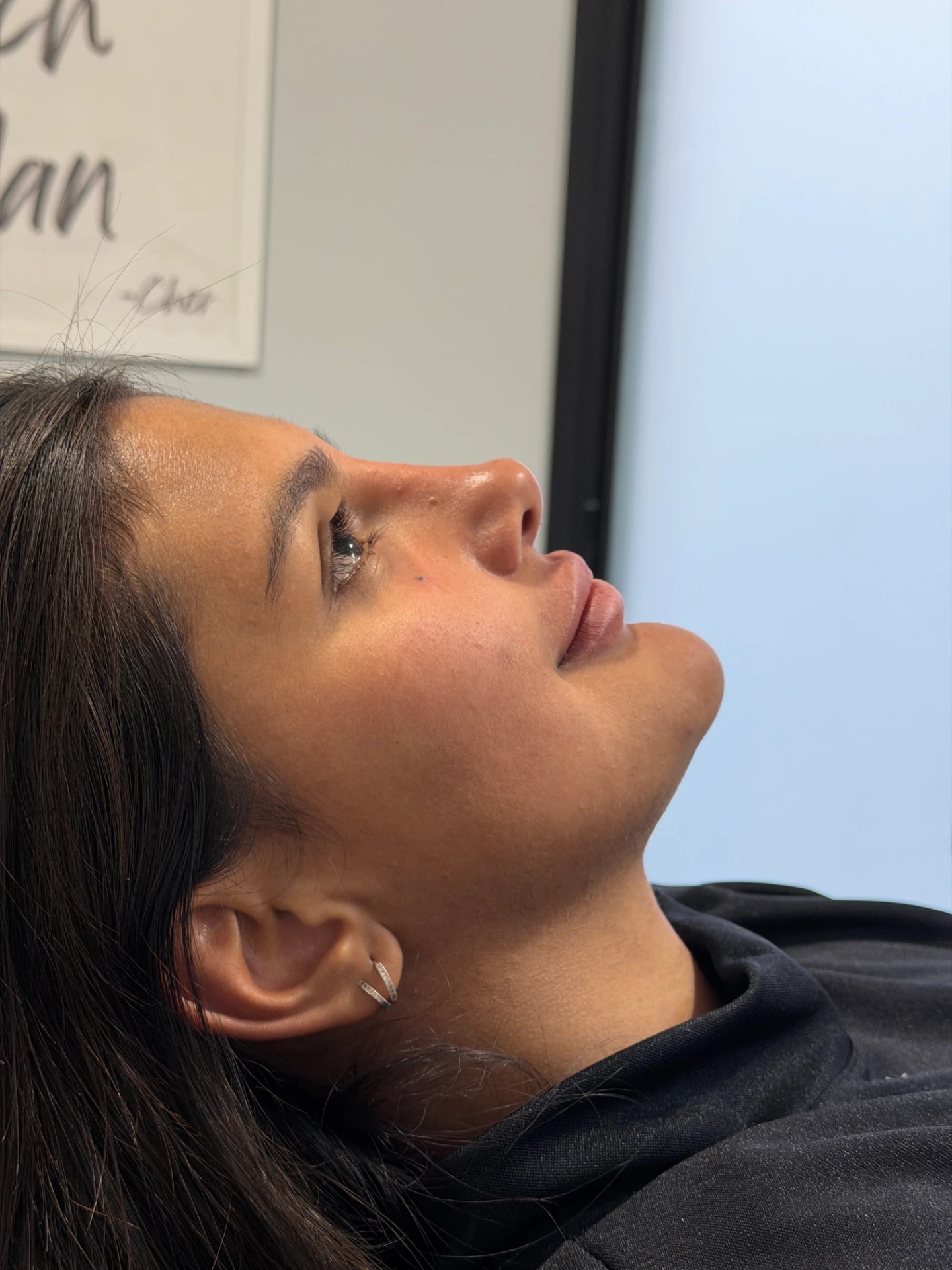Harmonização facial — proporção e realce dos traços naturais — depois do tratamento