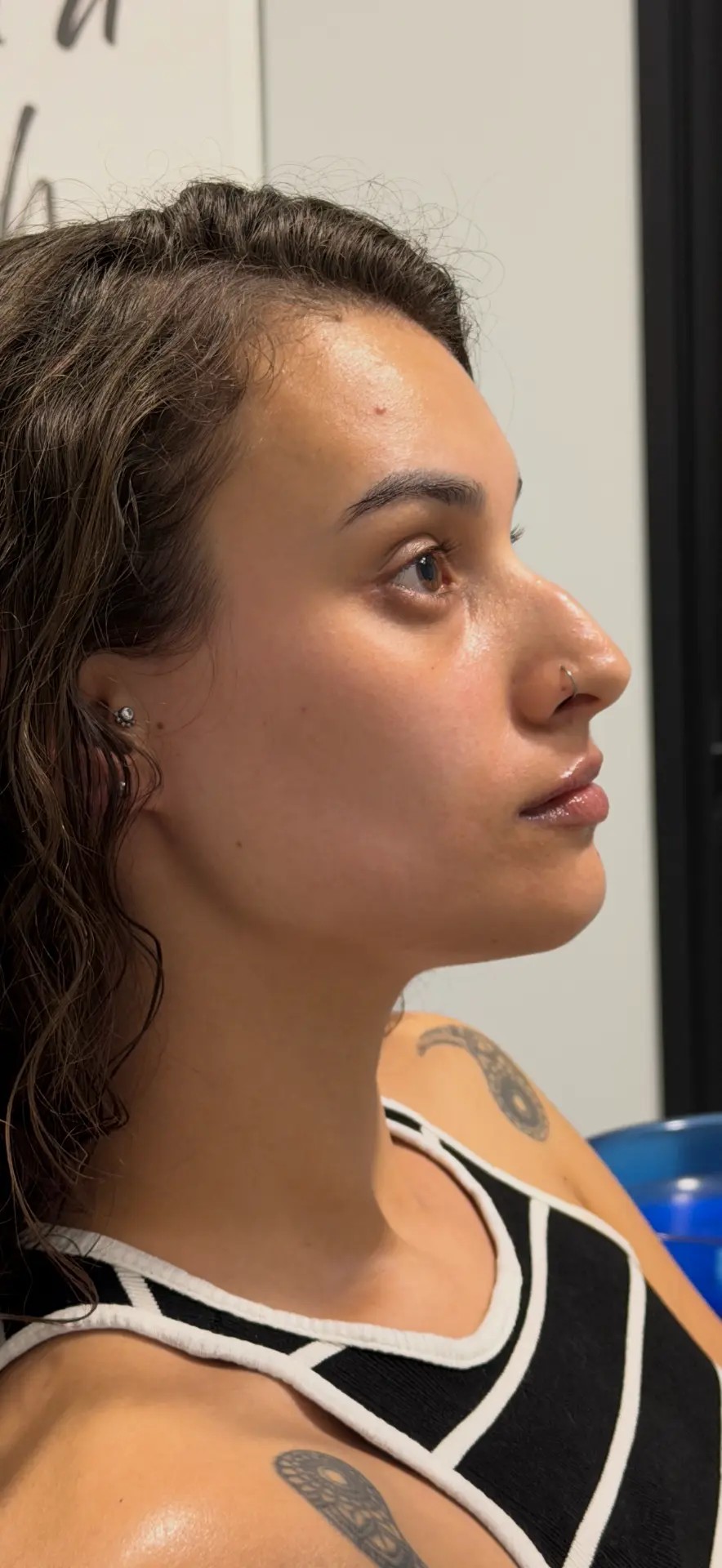 Harmonização facial — equilíbrio de perfil e contorno labial — antes do tratamento